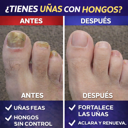 Parches AntiHongos 21unid + 1 par plantillas ortopédicas ajustables
